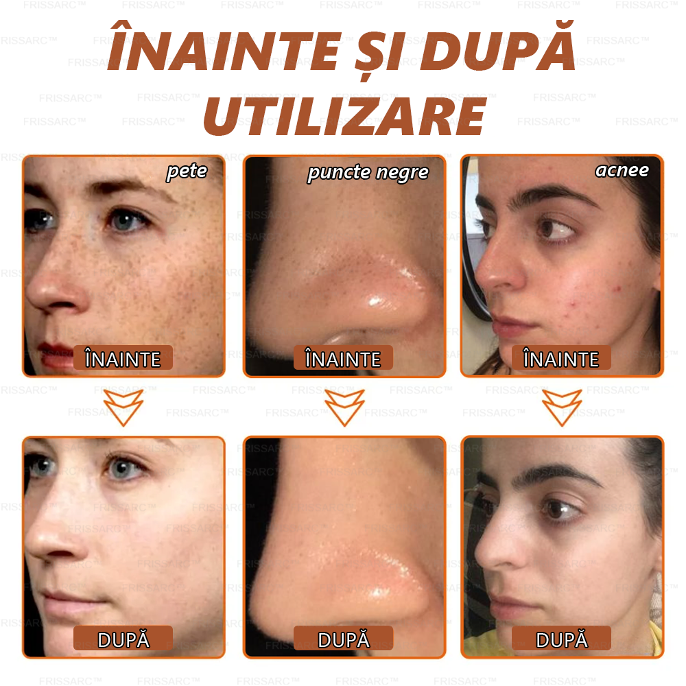 🎁FRISSARC™ masca facială  pentru albire și îndepărtarea petelor –✅Ingredientele naturale ajută la eliminarea eficientă și de durată a petelor pigmentare, petelor de vârstă, pistruilor și petelor solare.