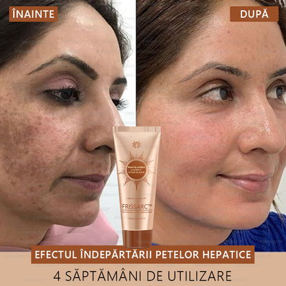 🎁FRISSARC™ masca facială  pentru albire și îndepărtarea petelor –✅Ingredientele naturale ajută la eliminarea eficientă și de durată a petelor pigmentare, petelor de vârstă, pistruilor și petelor solare.